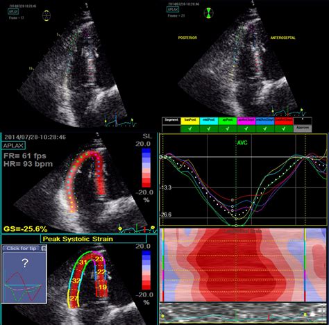 lv strain adalah|Echocardiographic Strain in Clinical Pra.